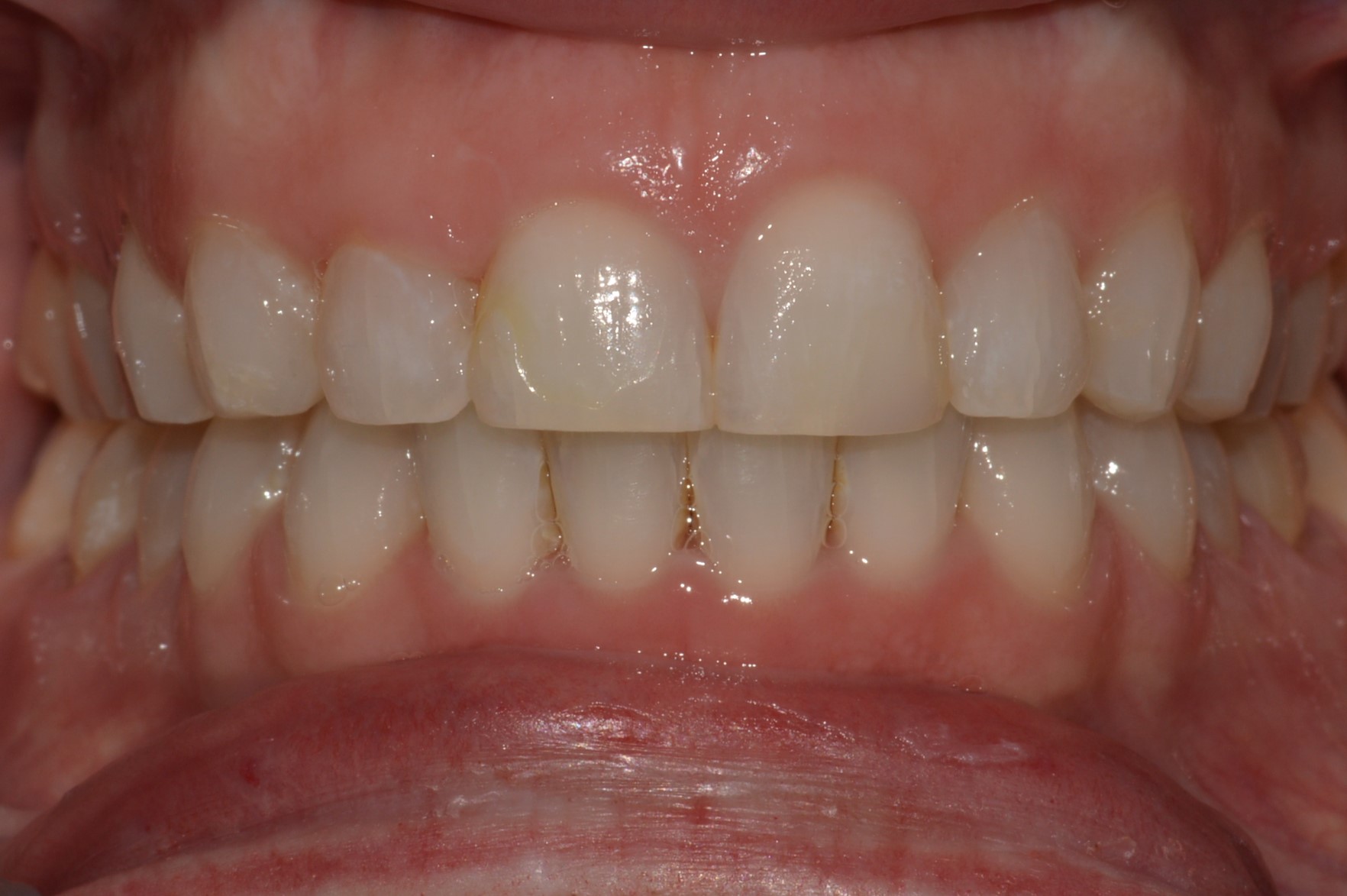 Overbite